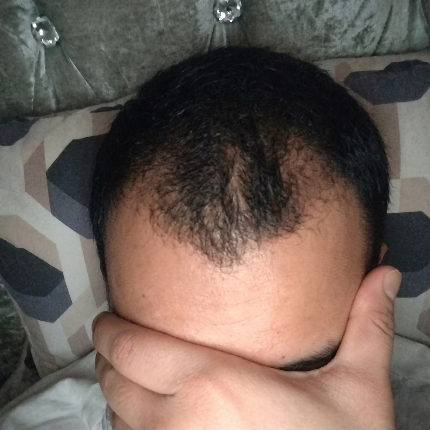 Before, scalp and hair prior to consistent use