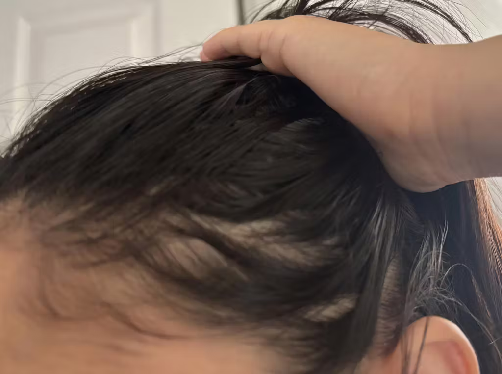 Before, scalp and hair prior to consistent use