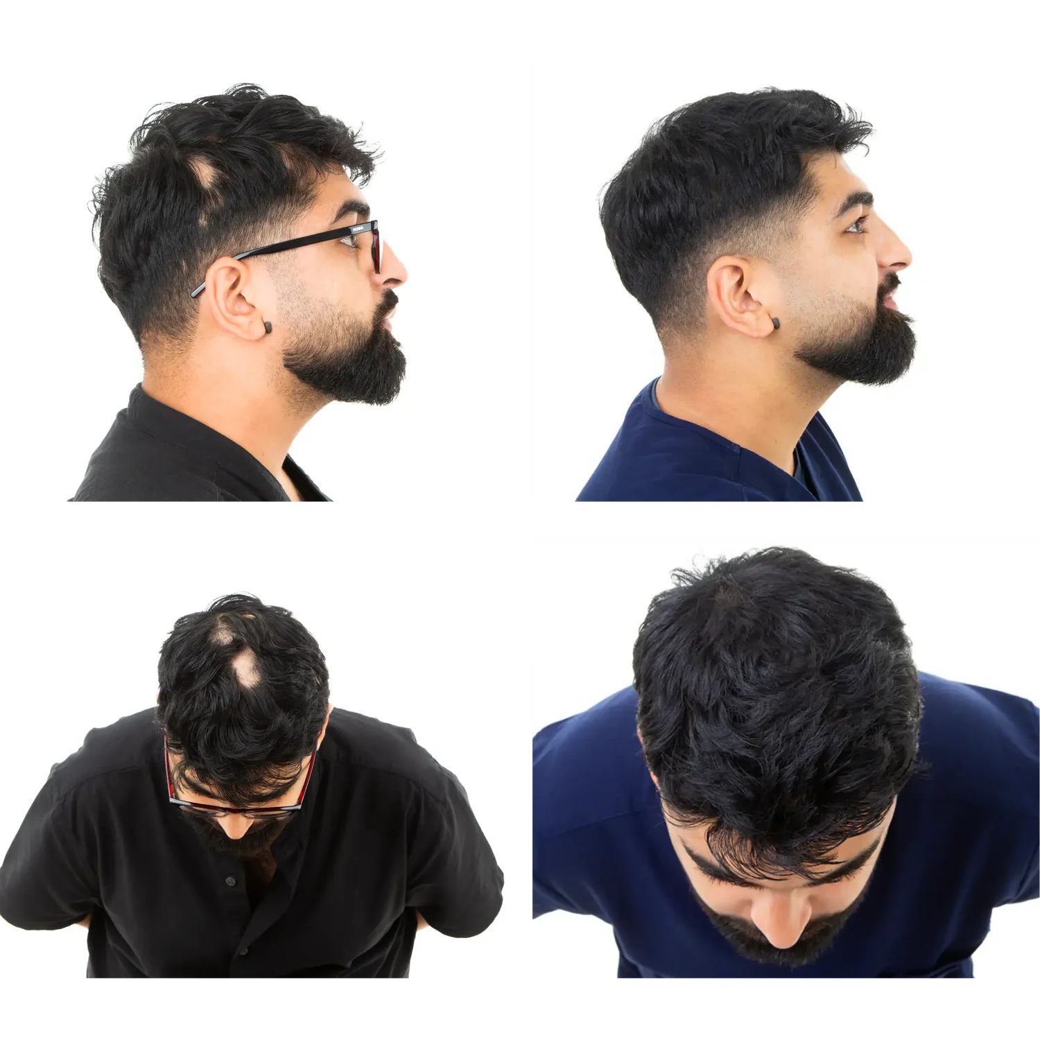 Dr. Yaseen Hussain hair density progress on his own Locks & Mane formula